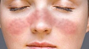 Lupus